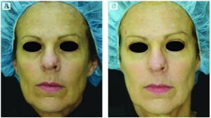 Figure 4 (A) This 55-year-old patient had moderate photoageing and dyschromia on the forehead and lateral cheek areas. (B) After four laser treatments in combination with the skincare regimen, improvement is seen at the forehead and bilateral cheek areas
