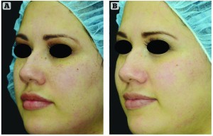 Figure 5 (A) This 31-year-old Hispanic patient had mild lentigines of the upper and lateral cheek area. (B)  Improvement is noted after four laser treatments  