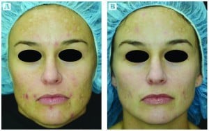 Figure 6 (A) This 37-year old Caucasian patient had moderate melasma and photodamage on the forehead and bilateral cheeks. (B) Improvement is noted after three laser treatments 