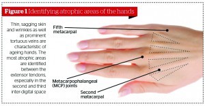 Thin, sagging skin and wrinkles as well as prominent tortuous veins are characteristic of ageing hands. The most atrophic areas are identified between the extensor tendons, especially in the second and third inter-digital space