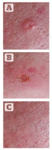 (A) Facial wart before treatment; (B) immediately after treatment; (C) 2 months post-treatment