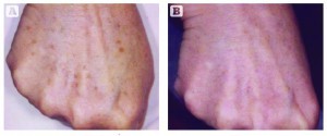 Figure 2 (A) Before and (B) after treatment with a Ruby laser