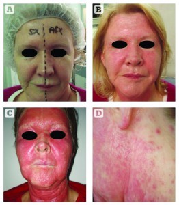Figure 2 Each half face was randomly assigned to receive treatment with one of the CO2 lasers. (A) Split-face study day 1; (B) split-face study day 3; (C) patient on day 5 with full facial herpes; (D) satellite herpetic lesions