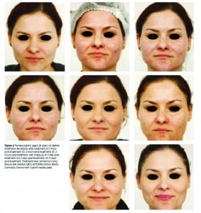 Figure 2 Female patient, aged 28 years. (A) Before treatment; (B) directly after treatment; (C) 1-hour post-treatment; (D) 2 hours post-treatment; (E) 2 hours post-treatment, with make-up; (F) 1-day post treatment; (G) 2 days post-treatment; (H) 3 days post-treatment. Treatment was carried out using Revive mn (amiea med, MT.DERM GmbH, Berlin, Germany), Revive-HAP, 6-point needle plate