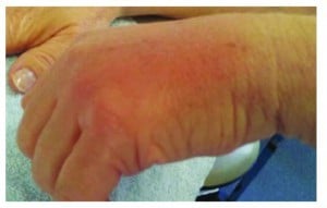 Inflammation and swelling of the left hand after single bolus injection with a sharp needle (right hand blunt cannula)