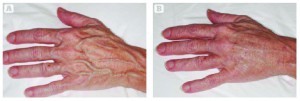 Figure 3 (A) Before and (B) after fat transfer to the hand
