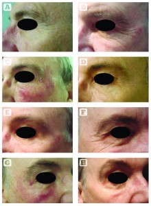 Figure 4 The patient was a 53-year-old Caucasian male with bilateral periorbital rhytides. Left eye treated with SmartXide — 30 W, Dot mode, spacing 200 μm, dwell time 500 μs. Two passes were given under the left eye, with an obvious reduction in rhytides. The right eye was treated with the Lumenis ActiveFX — 100 mJ, 125 Hz, CPG 3/5/2. (A) SmartXide before treatment (eye open); (B) SmartXide before treatment (eye partially closed); (C) SmartXide on day 4; (D) SmartXide on day 14; (E) SmartXide on day 30; (F) ActiveFX before treatment; (G) ActiveFX day 4; (H) ActiveFX day 30