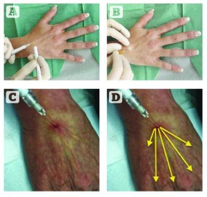 Single proximal insertion point (SPIP) technique; (A) marking of the insertion point; (B) creating entry point with a sharp needle; (C) and (D) insertion of the blunt cannula and filling of a number of metacarpal spaces from a single injection point in a fanning technique