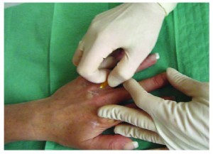 Single distal insertion point (SDIP) with cannula
