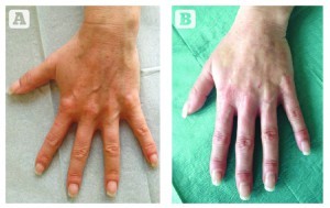 (A) Before and (B) after augmentation in distal single injection point with a blunt cannula