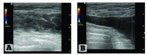 Figure 1 Ultrasound structure of the right mammary gland. (A) Patient 1, 45 years old, 9 years after ABA; (B) Patient 2, 26 years old, 2 years after ABA 