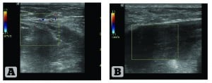 Figure 2 Ultrasound structure of the left mammary gland. (A) Patient 1, 45 years old, 9 years after ABA; (B) Patient 2, 26 years old, 2 years after ABA