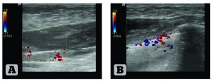 Figure 3 Ultrasound structure and blood flow of the right mammary gland. (A) Patient 1, 45 years old, 9 years after ABA; (B) Patient 2, 26 years old, 2 years after ABA