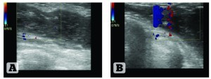 Figure 4 Ultrasound structure and blood flow of the left mammary gland. (A) Patient 1, 45 years old, 9 years after ABA; (B) Patient 2, 26 years old, 2 years after ABA