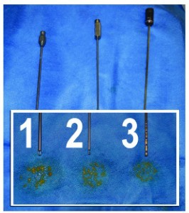 Different generations of lipo-harvesting cannulae and their effect on fat particle size. (1) Classic Coleman (opening diameter 2 mm by 2.8 mm, 1986); (2) ‘refined harvesting cannula’ (opening diameter 1.8 mm, KMI® (Innovative Med Inc., Corona, CA, US), 2002); (3) Micro-harvesting cannula (opening diameter 1 mm, type Tonnaerd, Tulip® (Tulip Medical Products, San Diego, CA, US), 2010)