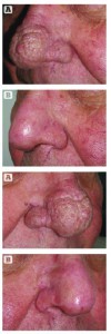 Figure 10 This patient was treated for advanced rhinophyma and is shown (A) before and (B) 90 days after  treatment with CO2 laser and radiosurgery