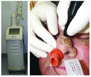 Figure 3 The Lumenis Encore laser (A) with the 3.0 mm spot handpiece (B) ablating nasal tissue