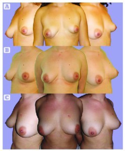 Figure 4 A 24-year old woman with evident breast asymmetry; (A) pre-operative, (B) 4 months postoperative after 320 cc of lipofilling and the BRAVA system, (C) 14 months postoperative, after gaining weight (4 kg) both breast increased equally in size.