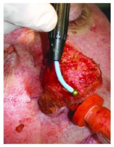 Figure 4 The Ellman Ball electrode is shown being used to cauterise and reduce hyperplastic tissue in rhinophyma surgery