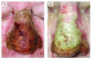 Figure 5 Healing is similar to other skin resurfacing procedures and open wound treatment with petrolatum. (A) Patient immediately after excision and (B) 72 hours post-treatment