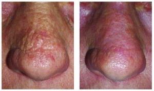 Figure 6 This patient was treated with laser and radiosurgery for minor rhinophyma changes on the nasal bridge