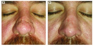 Figure 8 (Above) This patient was treated with laser and radiosurgery for minor rhinophyma changes on the central nose