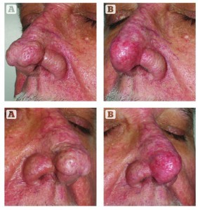 Figure 9 (Below) This patient was treated for advanced rhinophyma with laser and radiosurgery and is shown (A) before and (B) 8 weeks after treatment