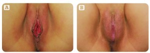 Figure 1 (A) Before and (B) after ‘barbie’ RF labiaplasty