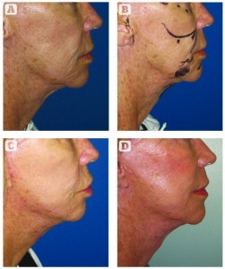 Figure 2 Patient underwent laser treatment of the face with the 1064 nm/1320 nm laser prior to facelift. (A) Before treatment; (B) with preoperative marks applied; (C) 2 months after procedure, results look good but with some erythema of the surgical scars; (D) at 9 months the erythema has diminished