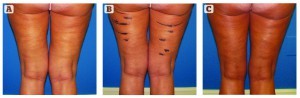 Figure 3 (A) Before treatment, (B) with preoperative marks applied, and (C) 5 months after laser-assisted liposuction of the posterior thighs and knees with fat grafting areas of depression in her posterior thighs