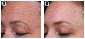Figure 5 Skin active regimen with Neostrata Skin Active range (A) before and (B) after 16 weeks