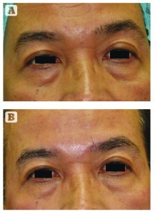 Figure 6 Periorbital iFine treatment in a 60-year-old male patient. (A) Baseline and (B) after six treatment sessions. There is a significant reduction of the tear trough