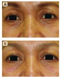 Figure 7 Periorbital iFine treatment in a 60-year-old female patient. (A) Baseline and (B) after six treatment sessions. There is a significant reduction of wrinkles and lifting of upper eyelid