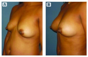 Figure 1 (A) Before and (B) after lipografting in the breast