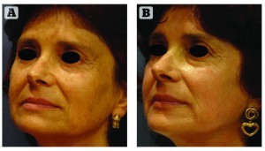 Figure 1 Patient (A) before and (B) 1 week after one medium‑depth peel