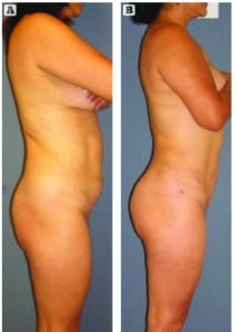 Figure 2 (A) Before and (B) after lipografting in the buttocks 