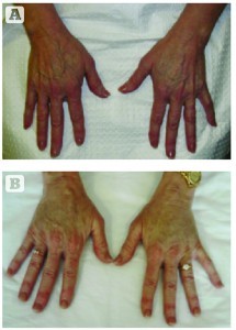 Figure 3 Hand rejuvenation with lipografting, (A) before and (B) after 