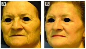 Figure 3 Patient (A) before and (B) 8 weeks after one deep peel