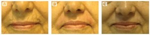 Figure 4 Patient (A) before,  (B) 15 days post-treatment, and (C) 1 year after a deep peel to the upper perioral area