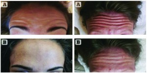 Figure 3 Before and after photos of patients who underwent FCT (all at maximum raise of eyebrows). Improvement in dynamic wrinkle severity at maximum raise of eyebrows was seen immediately post FCT. The treatment can be tailored to the extent of the individual’s desire. (A) Patient 1 before, (B) patient 1 after treatment. (C) Patient 2 before, (D) patient 2 after treatment