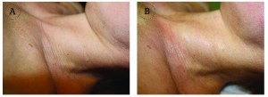 Figure 10 Rejuvenation procedures applying non-cross-linked hyaluronic acid, and using a cannula technique. (A) Before and (B) after rejuvenation of the neck