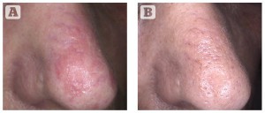(A) Before and (B) after one treatment session. Rosacea treatment with the CLARITY 755 nm Alexandrite laser. Images courtesy of Bettina Rümmelein, MD, Switzerland