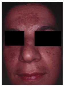 Figure 1 Melasma with irregular, brown plaques on the forehead and cheeks