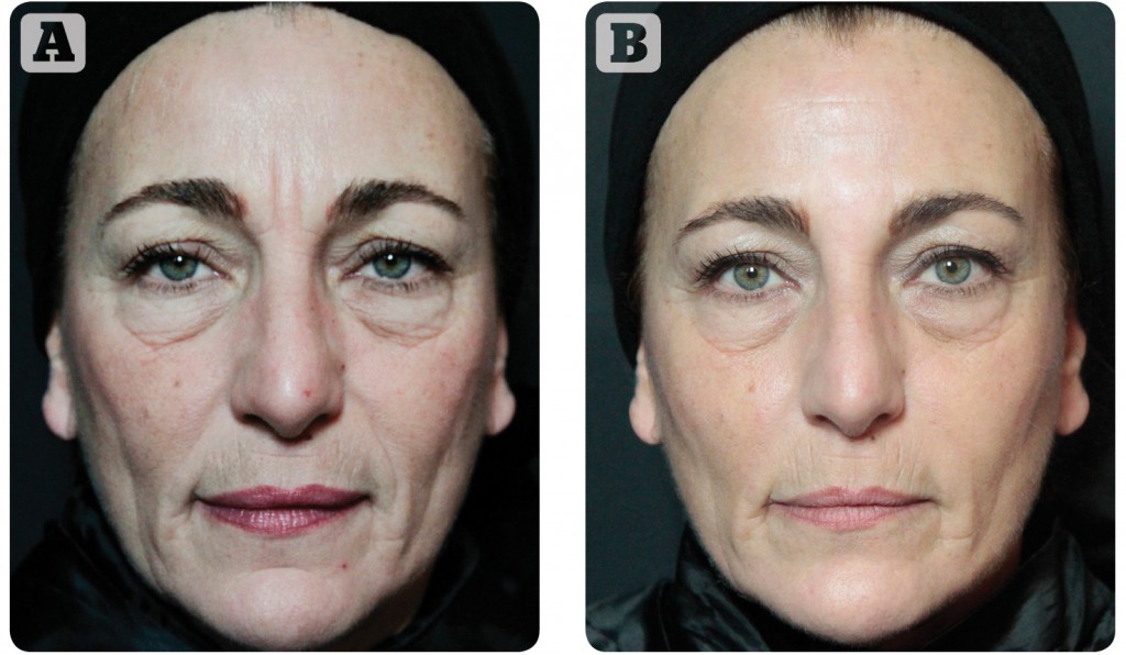 Hydrolift® Action: a new approach to a full face treatment | PRIME Journal