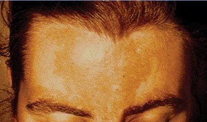 Figure 2 Melasma on the forehead