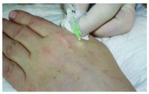 Figure 6 Infiltration anaesthesia of the cannula’s injection point as part of a procedure to rejuvenate the hands