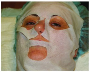 Figure 7 On completion of the rejuvenation treatment, the author lays a mask or cloth soaked in chlorhexidine on all treated areas for 5 minutes