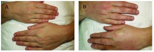Figure 9 Rejuvenation procedures applying non-cross-linked hyaluronic acid and platelet-rich plasma. (A) Before and (B) after rejuvenation of the hands