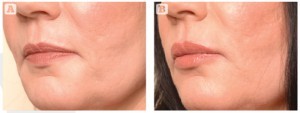 Figure 1 Enhancement achieved by following the ideal concepts of beauty (respecting the ratio between the upper and lower lip, and avoiding hyper-augmentation of the lips) adds to feminine traits. (A) Before and (B) after