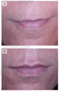Figure 2 Augmenting the philtrum and ‘cupid bow’ shortens the upper lip’s appearance. (A) Before and (B) after